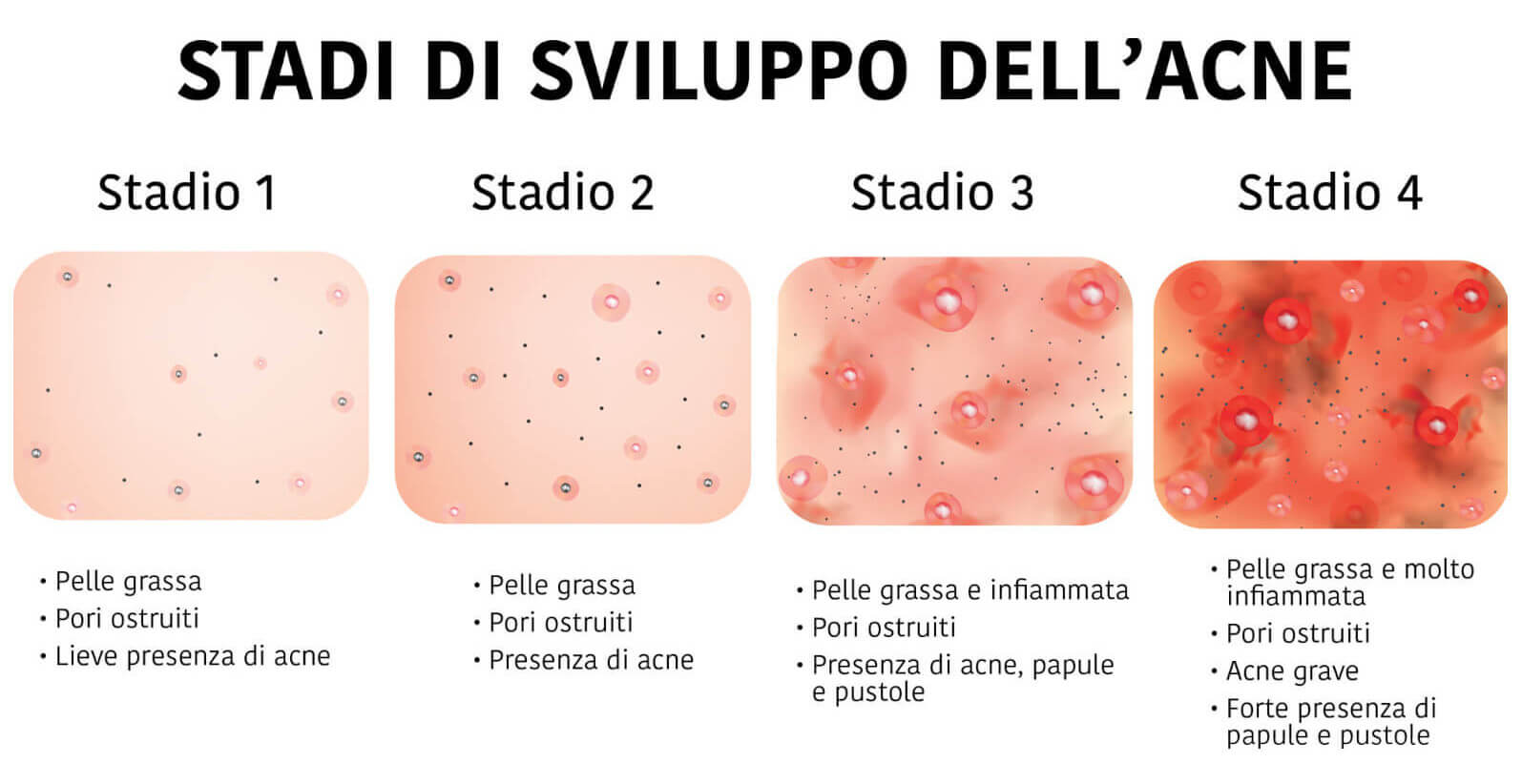 Gli stadi dell'acne