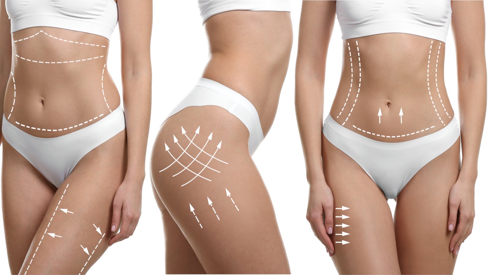 Dove si forma la cellulite